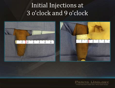 p shot before and after photos|Penile Girth Enhancement Before & After Photos .